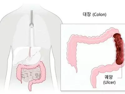 “암 사망자 10%가 대장암”… 내시경검사로 조기 발견