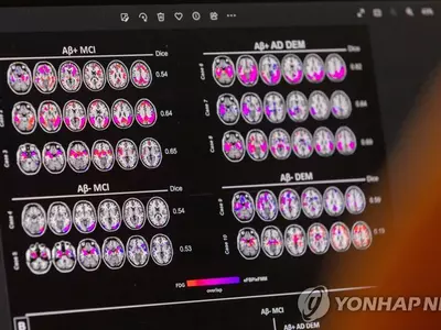 알츠하이머 치료 신약 나왔다