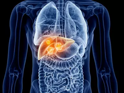 간암, 술보다‘이 질환’때문에 발병한다