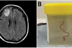 건망증 앓던 여성 뇌 속에 8㎝짜리 벌레가 '꿈틀'
