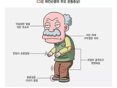 파킨슨병 새 방아쇠 찾았다…"신경세포 시냅스 장애가 출발점"