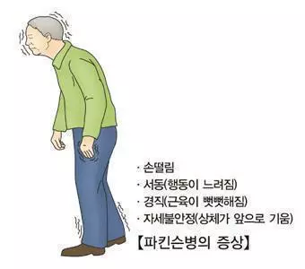 파킨슨병[서울아산병원 제공. 재판매 및 DB 금지]