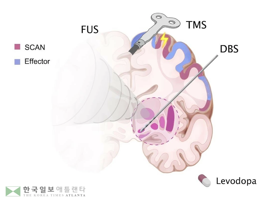 파킨슨병 '체성 인지 행동 네트워크'(SCAN) 표적 치료법경두개 자기자극(TMS)과 심부뇌자극(DBS), 집속초음파 자극(FUS), 약물(Levodapa) 등으로 뇌 SCAN 영역(보라색 부분)을 표적화해 치료하는 파킨슨병 치료법. [Jianxun Ren, Yi Li, Jiayi Zhu and Wei Zhang. 제공. 재판매 및 DB 금지]