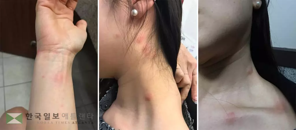 호텔 투숙 한인여성 벌레에 물렸는데....
