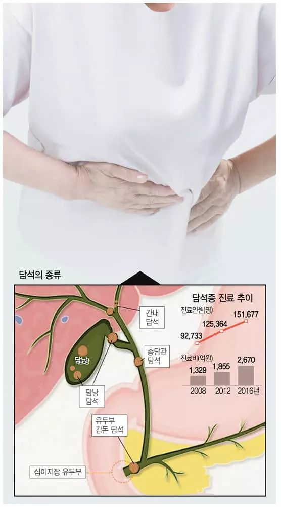 콕콕콕 쑤시는 복통… 몸속에 생긴 돌 때문?