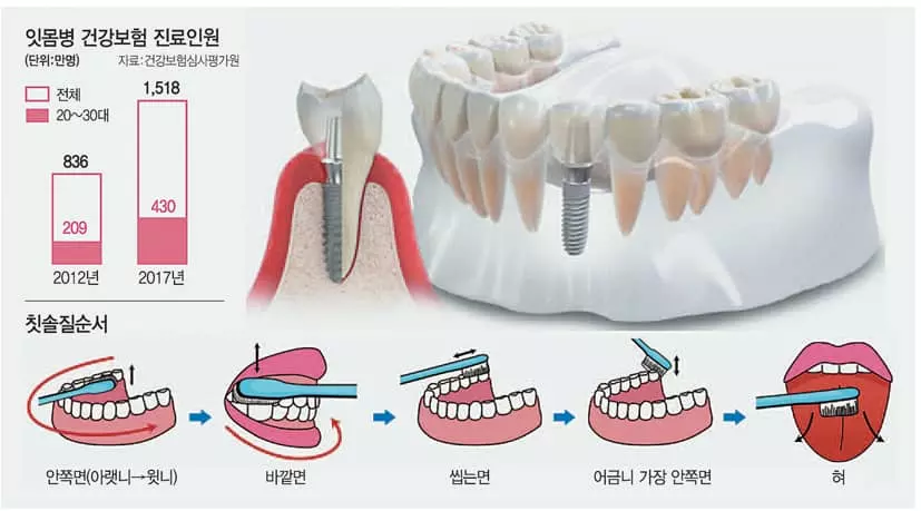 임플란트, 잇몸 염증 못 잡으면 ‘모래성’