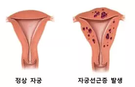 난임여성 10명중 1명 갑상선·부인과 질환