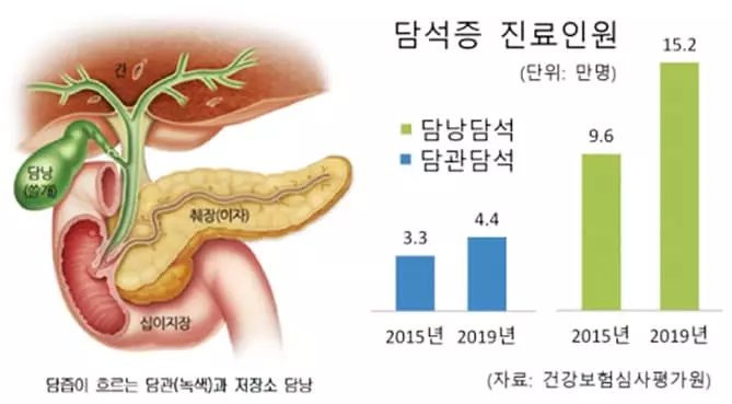 자주 체하고 명치부위 복통… 위에 이상 없으면 담석 때문?