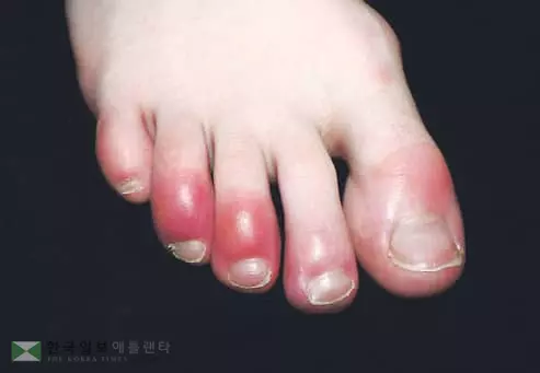 ‘발가락 붉은 발진’ 신종증세 확산