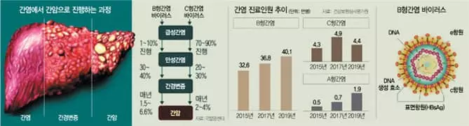 증상 없다고 방치했다간… 만성 간염이 간경화 부른다