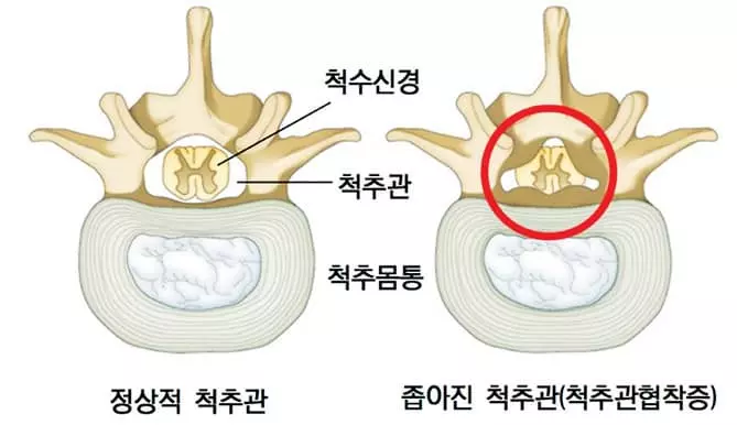 조금만 걸어도‘찌릿찌릿’척추관협착증 의심해야