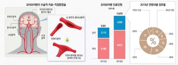 뇌혈관 좁아져 뇌졸중 초래…모야모야병, 어릴수록 진행 빨라