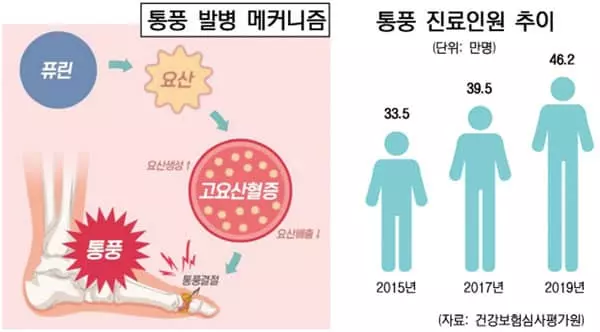 발가락 통증엔 소염제? 만성 통풍으로 키울라