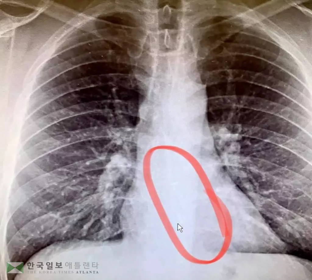 음악 들으며 잠자다 이어폰 삼킨 남성