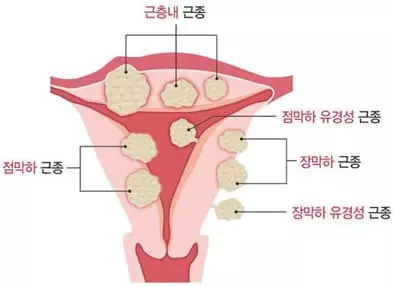 잘 모르는 자궁근종 궁금증 4가지