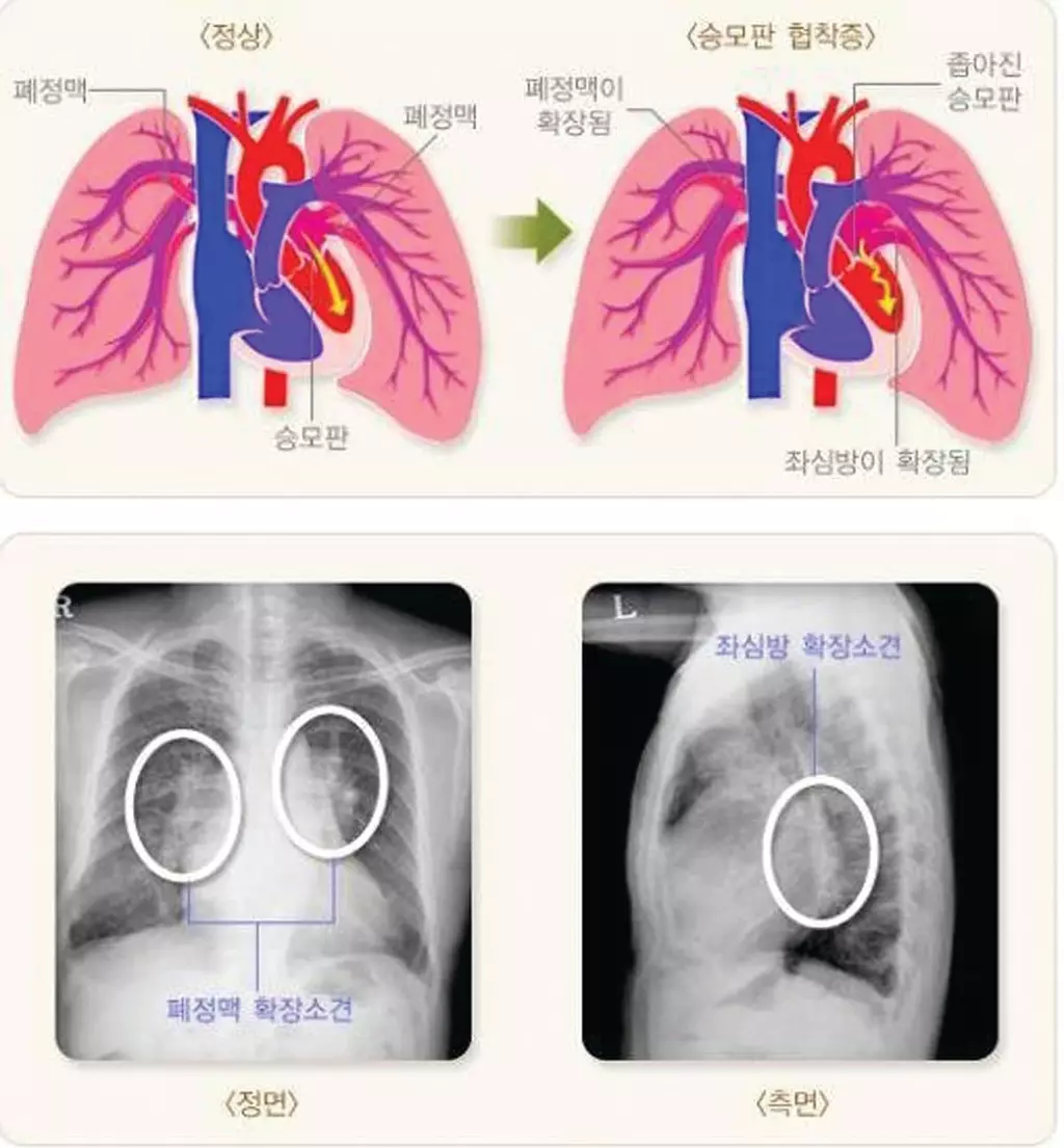 승모판막 폐쇄부전증,‘클립 이용한 시술’효과