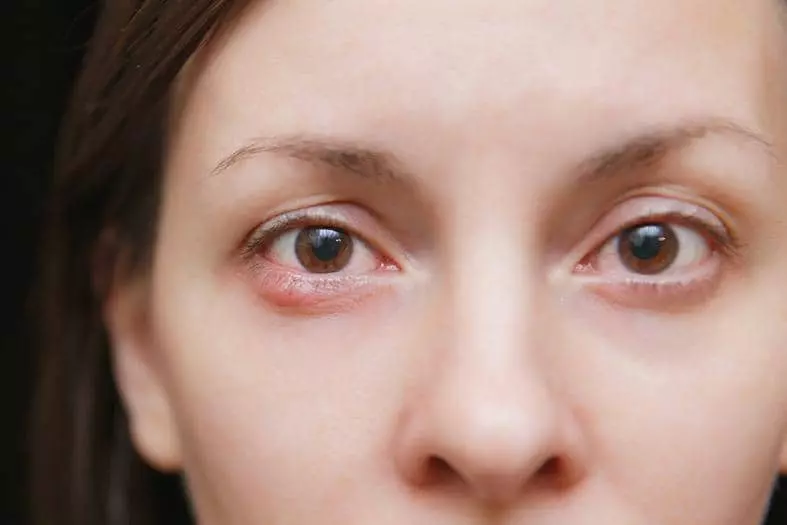 눈 떨림 증상은 대두분 수면 부족, 피로 누적, 마그네슘 등 전해질 불균형으로 생기지만 삼차신경통 때문에도 발생한다. 
