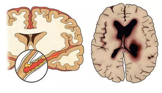 혈관이 막혀 뇌가 손상되면 ‘뇌경색’(왼쪽), 혈관이 터져 뇌가 손상되면‘뇌출혈’로 분류된다. 				                      <사진 제공=서울아산병원>