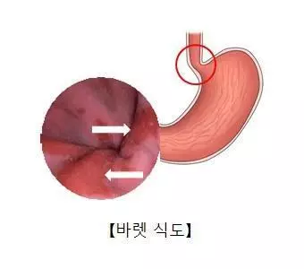 위산의 역류로 생기는 바렛 식도[서울아산병원 홈페이지 캡처. ]