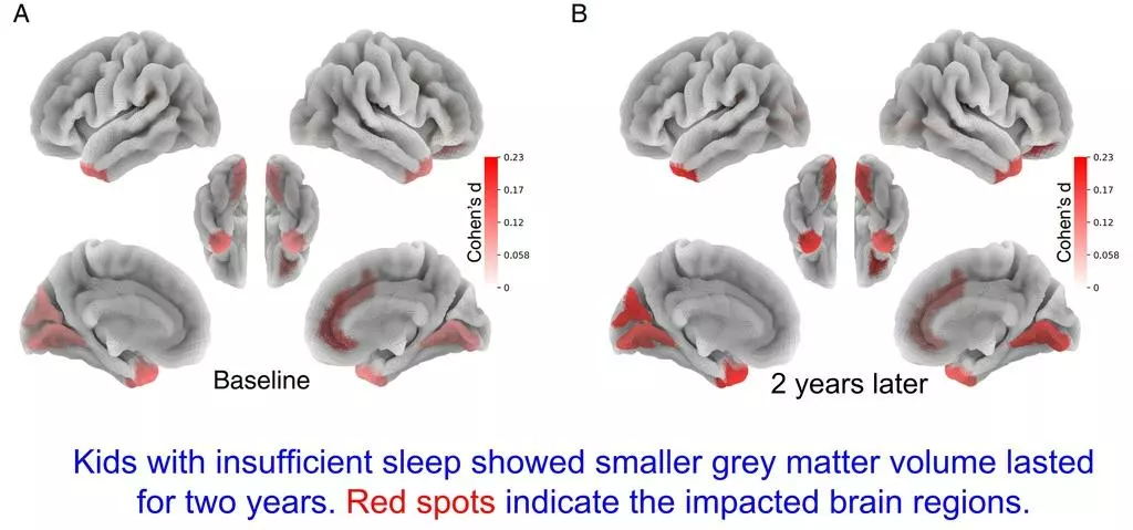 수면량에 따른 어린이 뇌 회백질 부피 변화 비교 MRI 사진수면 부족(하루 9시간 미만) 어린이는 조사 시작과 종료 시점에서 모두 충분히 자는 어린이들보다 의사결정, 충동 조절, 기억 등을 담당하는 회백질(빨간색 부분)의 부피가 감소한 것으로 나타났다. [메릴랜드대 의대 제공. 재판매 및 DB 금지]